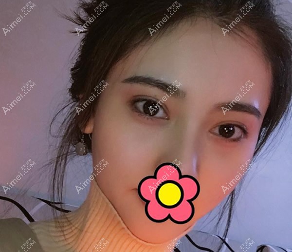 芜湖伊莱美徐世龙医生割双眼皮一个月效果 芜湖伊莱美徐世龙医生割双眼皮一个月效果