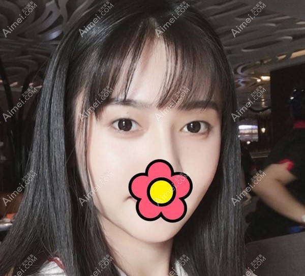 芜湖伊莱美整形外科医院割双眼皮前 芜湖伊莱美整形外科医院割双眼皮前
