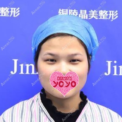 我在铜陵晶美整形做生态无痕双眼皮前 我在铜陵晶美整形做生态无痕双眼皮前