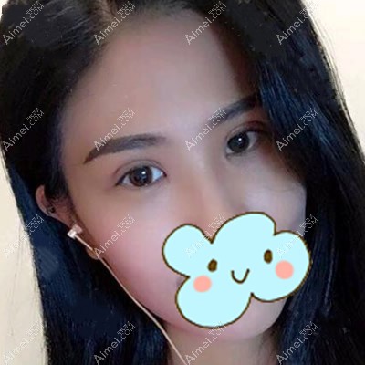 福州爱美尔全切双眼皮第7天拆线后图片 福州爱美尔全切双眼皮第7天拆线后图片