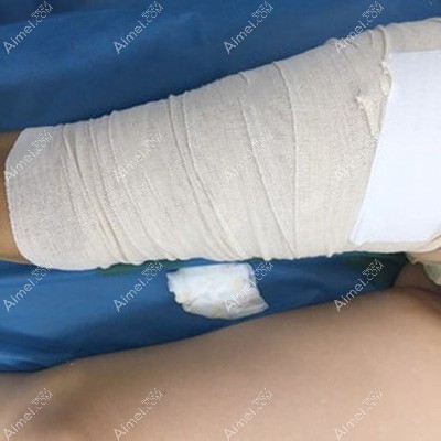大腿吸脂术后即刻包扎效果 大腿吸脂术后即刻包扎效果
