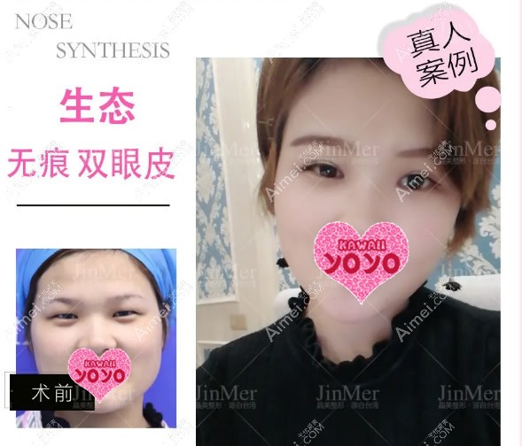 我在铜陵晶美做双眼皮前后对比照 我在铜陵晶美做双眼皮前后对比照