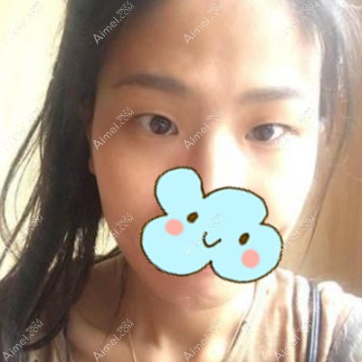 淮北相山爱美尔整形割双眼皮前 淮北相山爱美尔整形割双眼皮前