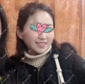 去宁波艺星做fotona全脸除皱术前照片 去宁波艺星做fotona全脸除皱术前照片