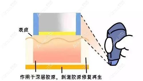 热玛吉面部抗衰原理 热玛吉面部抗衰原理
