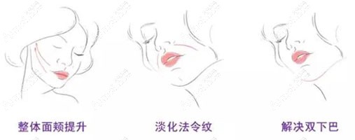 埋线提升抗衰原理 埋线提升抗衰原理