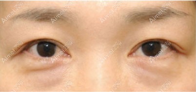 松弛型眼袋.jpg