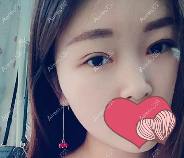 双眼皮2个月疤痕比较淡 双眼皮2个月疤痕比较淡