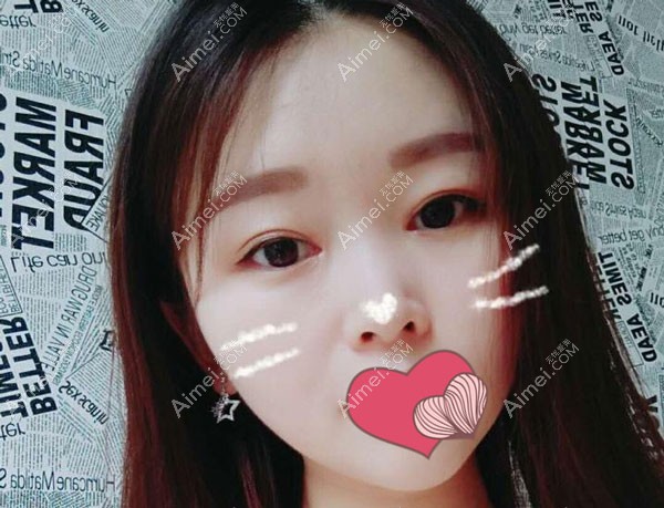 在保定华美做切开双眼皮5年后的恢复效果图 在保定华美做切开双眼皮5年后的恢复效果图