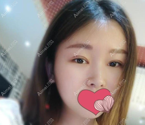 全切双眼皮6个月,看着很自然 全切双眼皮6个月,看着很自然