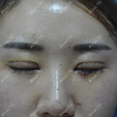 阜阳壹加壹割双眼皮第2天效果 阜阳壹加壹割双眼皮第2天效果