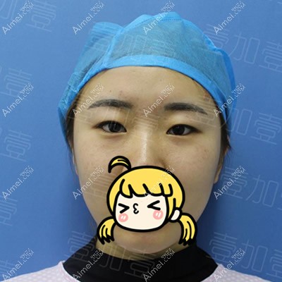 找阜阳壹加壹高影医生割双眼皮前 找阜阳壹加壹高影医生割双眼皮前