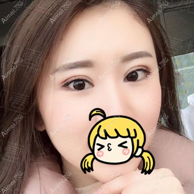 壹加壹高影给我割双眼皮第八天效果好不好 壹加壹高影给我割双眼皮第八天效果好不好