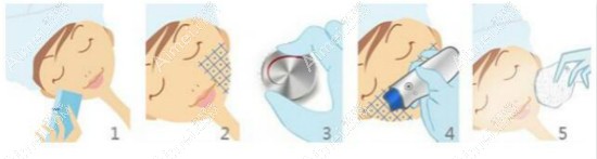 热玛吉四代和五代操作步骤一样