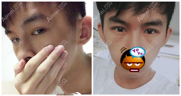 在长沙申美做的双眼皮术后恢复后效果 在长沙申美做的双眼皮术后恢复后效果