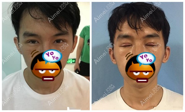 刚做完切开双眼皮的样子 刚做完切开双眼皮的样子