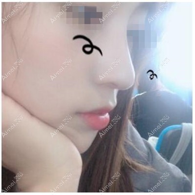 鼻综合术后2个月 鼻综合术后2个月