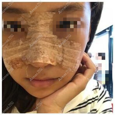 鼻综合术后3天 鼻综合术后3天