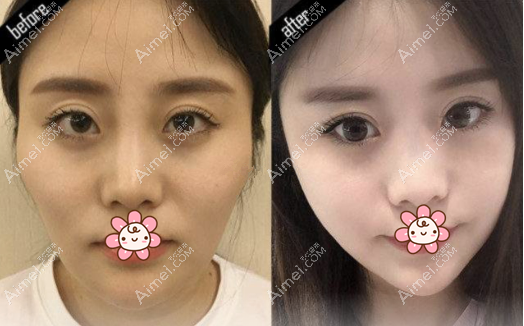 颧骨内推手术<span style= 颧骨内推手术<span style=