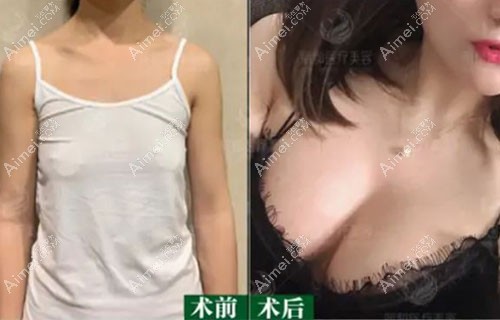 胸部扁平适合做水滴形还是圆形假体？235cc和250cc的区别大吗