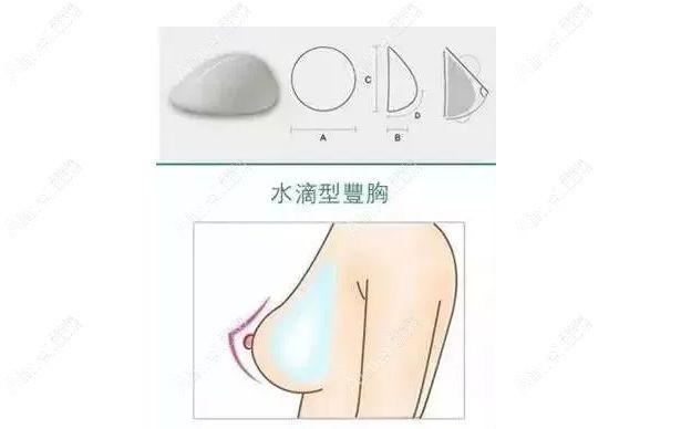 胸部扁平的顾客植入水滴形假体示意图.jpg 胸部扁平的顾客植入水滴形假体示意图.jpg