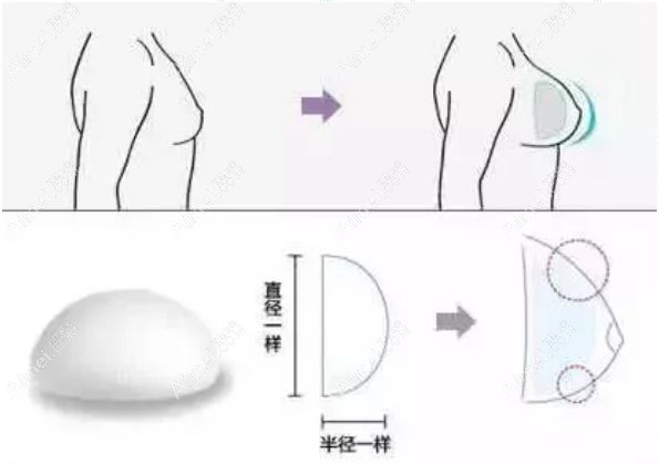 圆形假体植入A罩杯的胸部后示意图.jpg 圆形假体植入A罩杯的胸部后示意图.jpg
