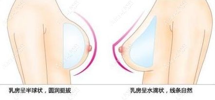 圆形假体和水滴型假体植入后对比<span style= 圆形假体和水滴型假体植入后对比<span style=