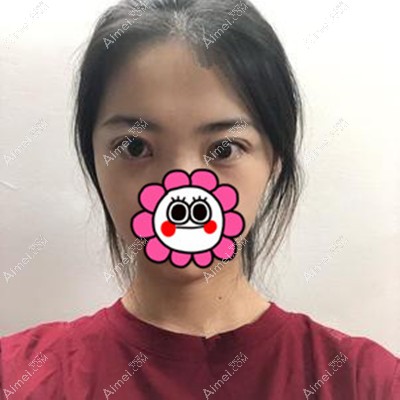 找重庆邓刚医生做了全切双眼皮修复，我的眼睛终于有神了