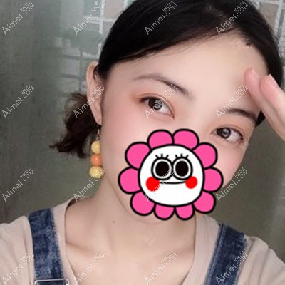 找重庆邓刚医生做了全切双眼皮修复，我的眼睛终于有神了