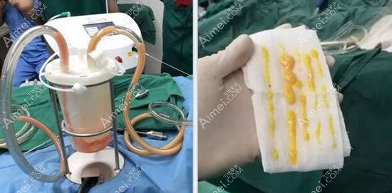 5g天使光雕抽取的脂肪可直接应用于自体脂肪填充.jpg 5g天使光雕抽取的脂肪可直接应用于自体脂肪填充.jpg