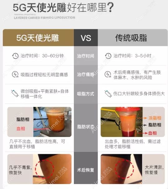 5g天使光雕对比传统吸脂手术的5大优势.jpg 5g天使光雕对比传统吸脂手术的5大优势.jpg