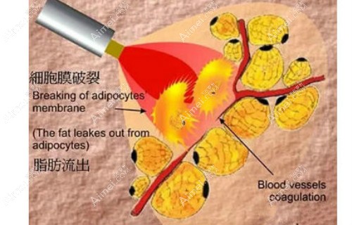 皮层光焊消除脂肪填充硬块 皮层光焊消除脂肪填充硬块