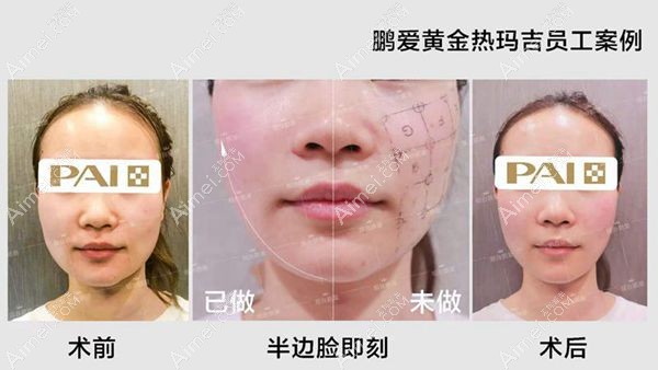 五代热玛吉900发做完全脸后即刻效果对比图.jpg 五代热玛吉900发做完全脸后即刻效果对比图.jpg