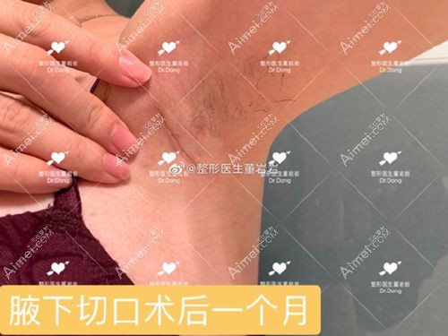 假体隆胸术后1个月腋下疤痕情况.jpg 假体隆胸术后1个月腋下疤痕情况.jpg
