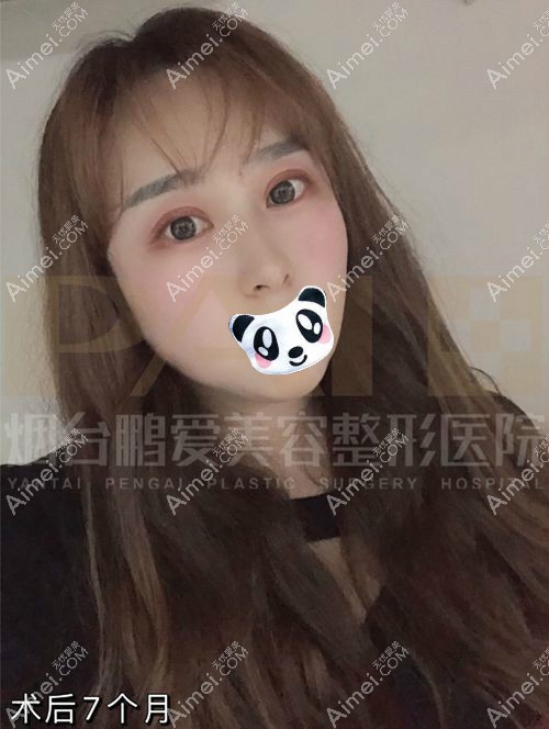 三眼皮变回双眼皮7个月效果展示.jpg 三眼皮变回双眼皮7个月效果展示.jpg