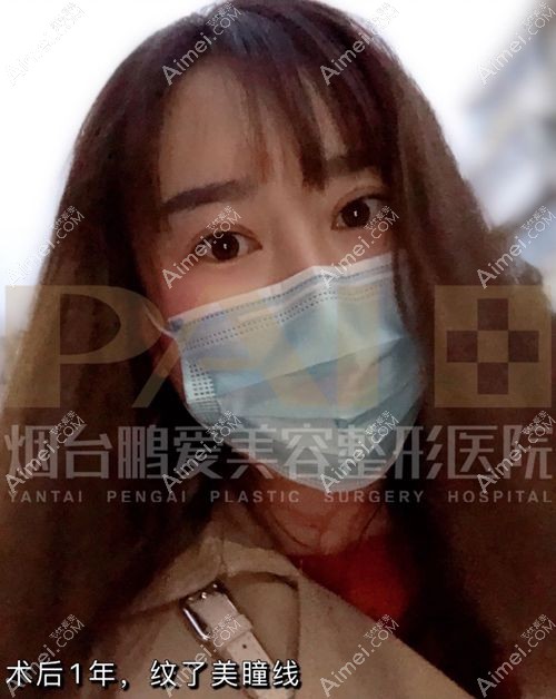 双眼皮失败修复1年后纹了美瞳线.jpg 双眼皮失败修复1年后纹了美瞳线.jpg