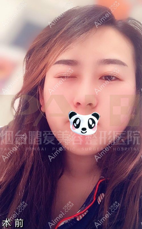 埋线双眼皮失败导致三眼皮.jpg 埋线双眼皮失败导致三眼皮.jpg