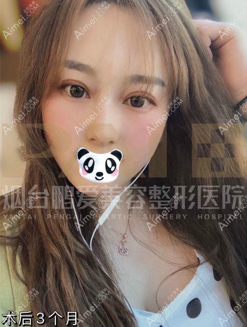 魏璐医生给我的三眼皮修复手术3个月恢复图.jpg 魏璐医生给我的三眼皮修复手术3个月恢复图.jpg