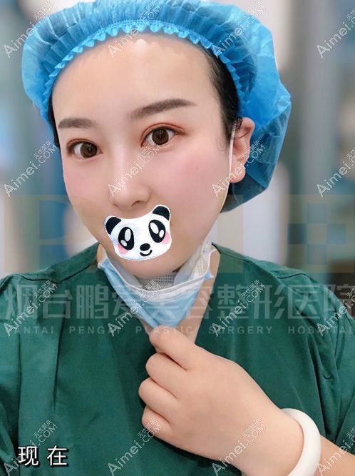 烟台鹏爱佳妍魏璐做的三眼皮修复手术1年了.jpg 烟台鹏爱佳妍魏璐做的三眼皮修复手术1年了.jpg