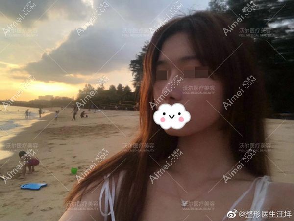北京沃尔汪洋医生膨体肋软骨鼻综合1个月案例.jpg 北京沃尔汪洋医生膨体肋软骨鼻综合1个月案例.jpg