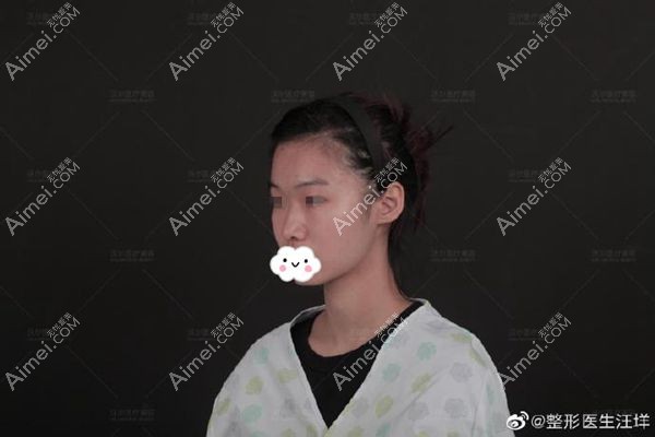 膨体肋软骨鼻综合术前45°侧面照.jpg 膨体肋软骨鼻综合术前45°侧面照.jpg