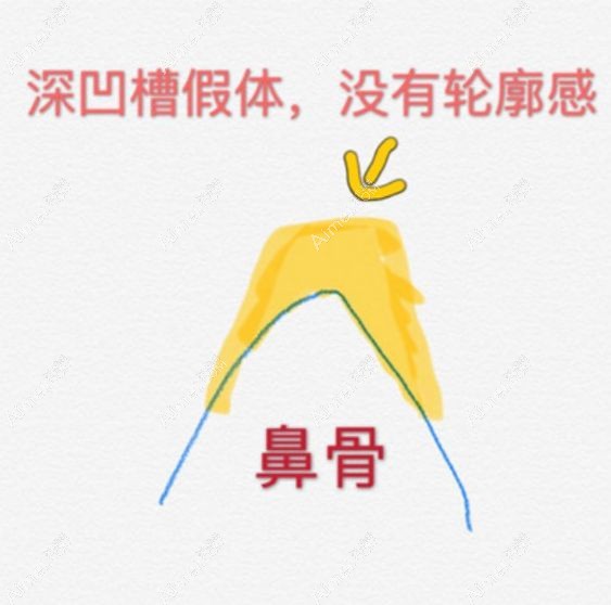 汪洋医生做膨体肋软骨鼻综合设计的深凹槽假体植入示意图.jpg 汪洋医生做膨体肋软骨鼻综合设计的深凹槽假体植入示意图.jpg