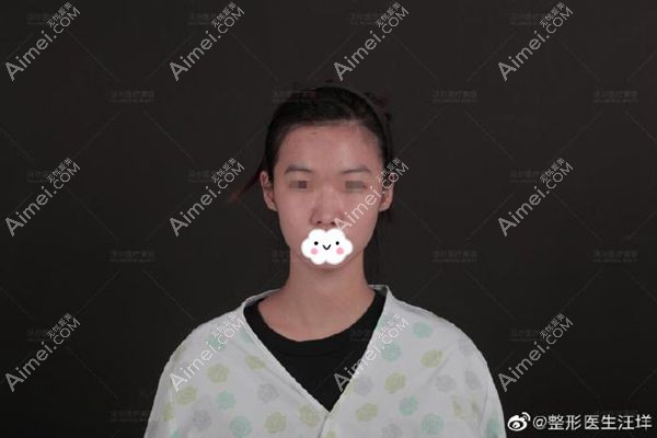 膨体肋软骨鼻综合术前正面照.jpg 膨体肋软骨鼻综合术前正面照.jpg