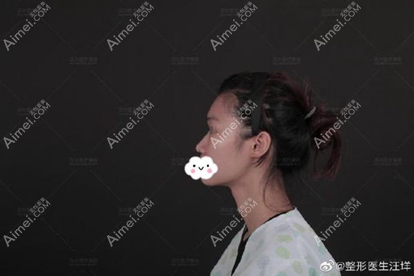 膨体肋软骨鼻综合术前90°侧面照.jpg 膨体肋软骨鼻综合术前90°侧面照.jpg