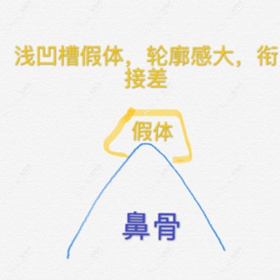 普通医生做膨体肋软骨鼻综合设计的深凹槽假体植入示意图.jpg 普通医生做膨体肋软骨鼻综合设计的深凹槽假体植入示意图.jpg
