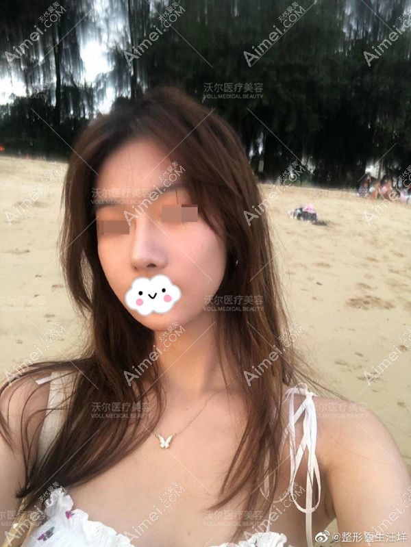 立秀膨体和肋软骨垫鼻尖鼻综合手术20天后效果图.jpg 立秀膨体和肋软骨垫鼻尖鼻综合手术20天后效果图.jpg