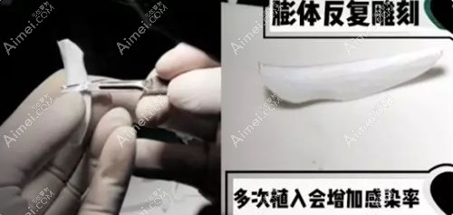 半肋软骨鼻综合中医生反复雕刻增加膨体增加感染风险.jpg 半肋软骨鼻综合中医生反复雕刻增加膨体增加感染风险.jpg
