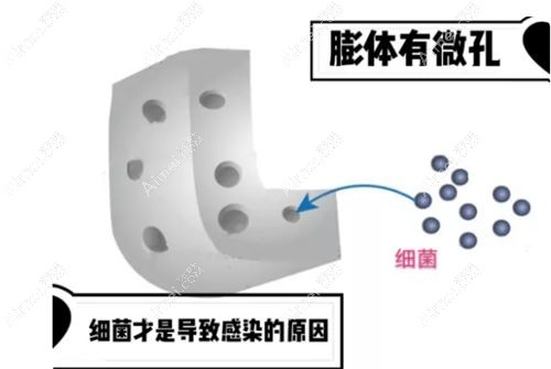 膨体假体垫鼻背导致半肋软骨鼻综合出现感染.jpg 膨体假体垫鼻背导致半肋软骨鼻综合出现感染.jpg