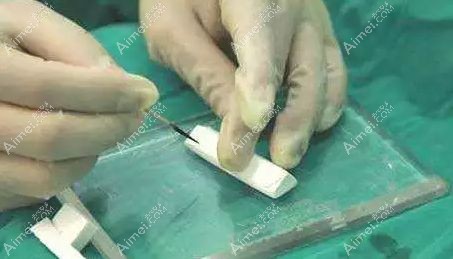 医生雕刻膨体假体用于半肋软骨鼻综合.jpg 医生雕刻膨体假体用于半肋软骨鼻综合.jpg