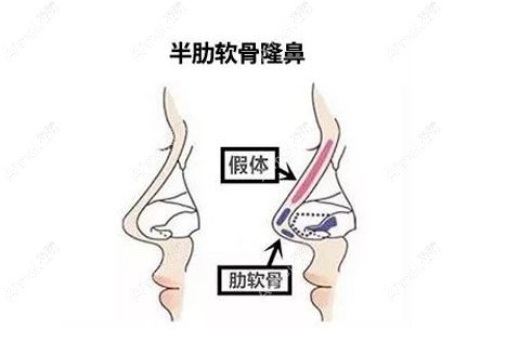 半肋软骨鼻综合中硅胶和膨体放置位置示意图.jpg 半肋软骨鼻综合中硅胶和膨体放置位置示意图.jpg